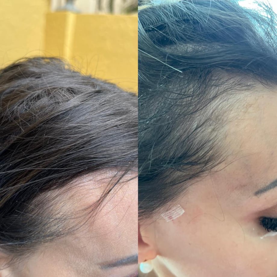 Hair Growth Before and After Loxahatchee, FL