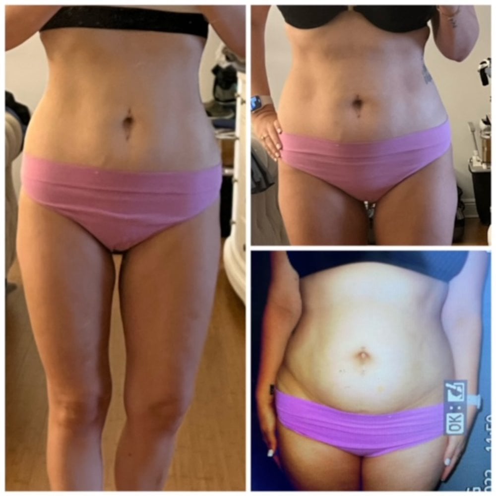 Weight Loss Before and After Wellington, FL